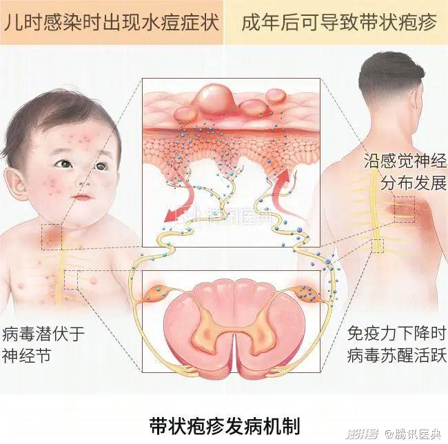 饮食带状疱疹后能喝酒吗_饮食带状疱疹后注意事项_带状疱疹愈后饮食