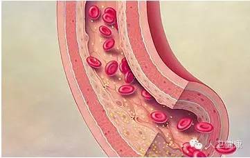 动脉硬化患者的饮食_动脉硬化的饮食指导_硬化饮食动脉患者能吃什么