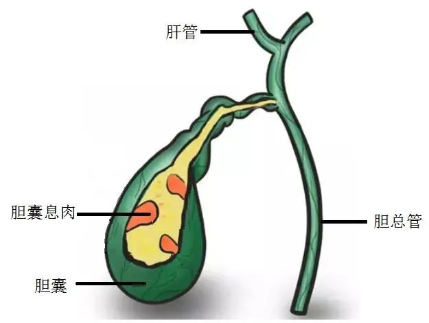 胆囊息肉手术后的饮食_饮食手术胆囊息肉后吃什么好_胆囊息肉手术术后