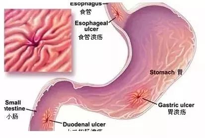胃复合饮食型溃疡的原因_复合型胃溃疡饮食_复合型胃溃疡该如何饮食