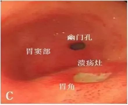 复合型胃溃疡该如何饮食_胃复合饮食型溃疡的原因_复合型胃溃疡饮食