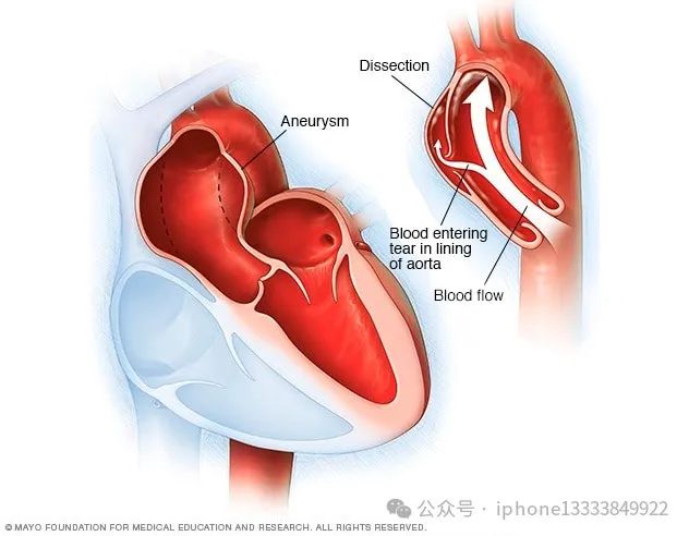 夹层动脉瘤饮食-动脉瘤动脉夹层