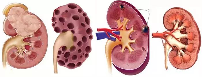 多发性肾囊肿吃什么食物好_多发性肾囊肿生活注意_多发性肾囊肿的饮食