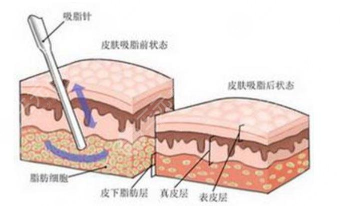 溶脂