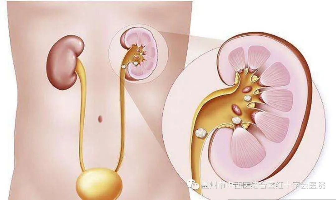 左肾结石饮食注意什么-肾结石在饮食上应该注意些什么