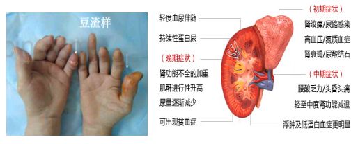 疼风性肾结石_痛风伴肾结石饮食注意事项_老年人痛风饮食应该注意什么