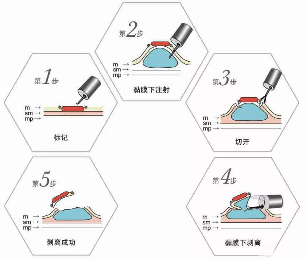 电胃饮食术切息肉后吃什么_电切胃息肉后什么时间能进食_胃息肉电切术后饮食