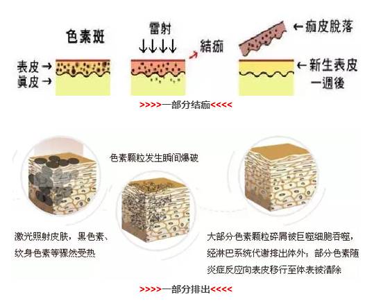 激光祛斑饮食手术后吃什么_激光祛斑饮食手术后注意什么_激光祛斑手术后饮食