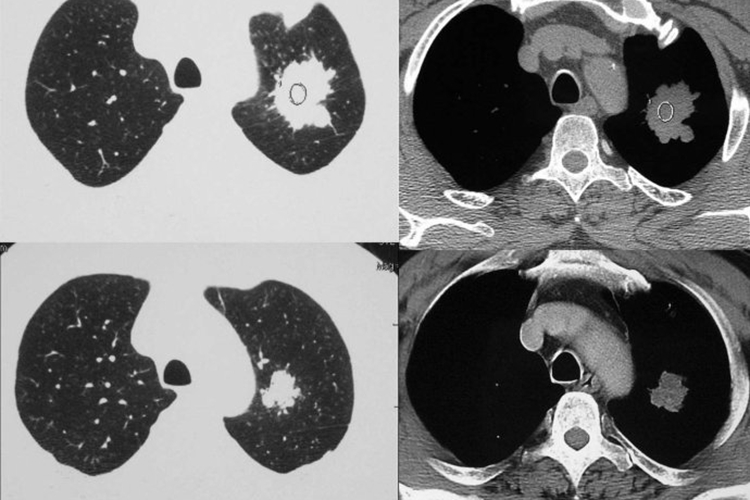 周围型肺癌CT图