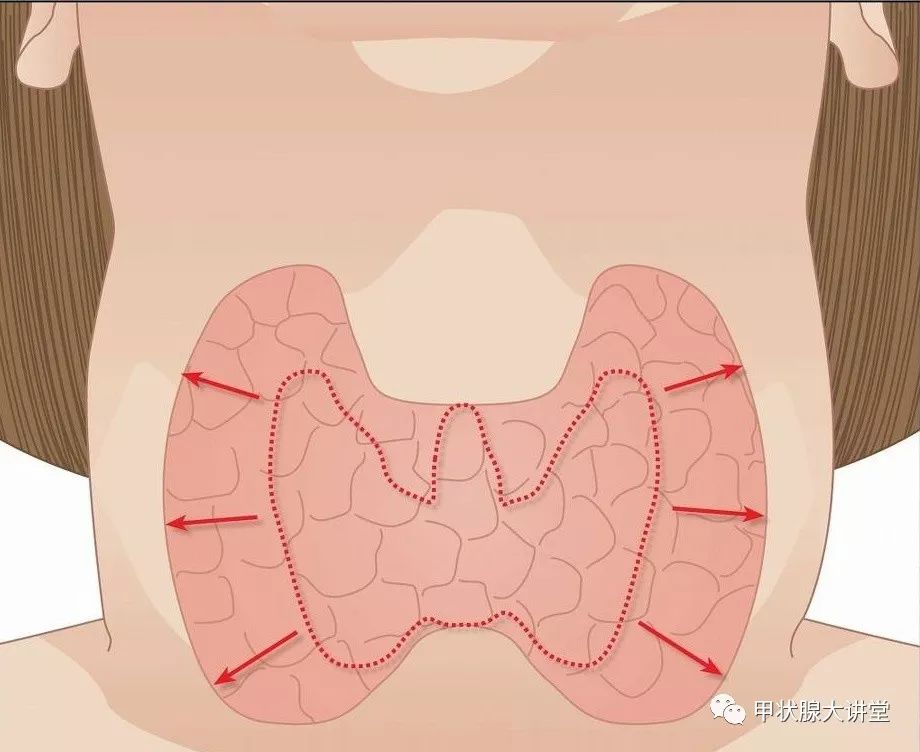 饮食甲状腺结节瘿瘤能消除吗_甲状腺结节瘿瘤饮食_饮食甲状腺结节瘿瘤严重吗