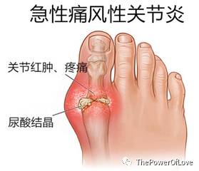 晚期肾衰竭临死前表现_晚期肾衰竭能活多久_肾衰竭晚期饮食注意事项