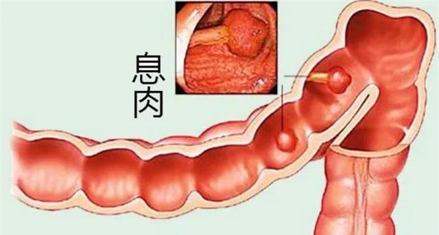 结肠息肉切除后饮食-切除饮食结肠息肉后注意事项