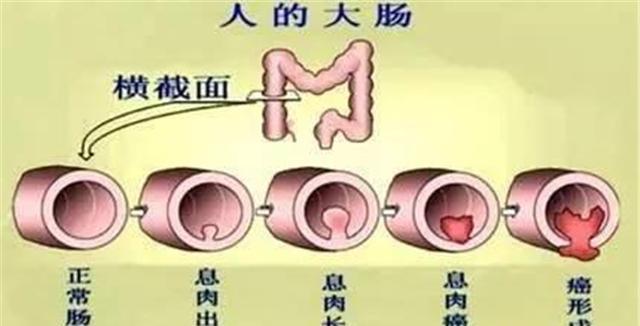 结肠息肉切除手术后_切除饮食结肠息肉后注意事项_结肠息肉切除后饮食