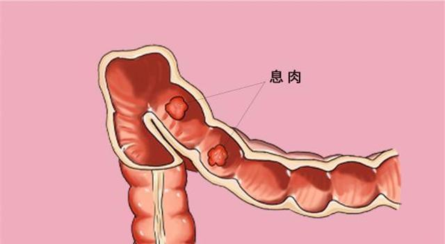 结肠息肉切除手术后_结肠息肉切除后饮食_切除饮食结肠息肉后注意事项