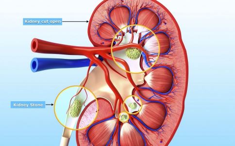 肾结石碎石后饮食注意什么-肾饮食碎石结石注意后注意什么
