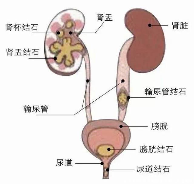 输饮食病人结石尿管会堵吗_输饮食病人结石尿管会堵塞吗_输尿管结石病人饮食