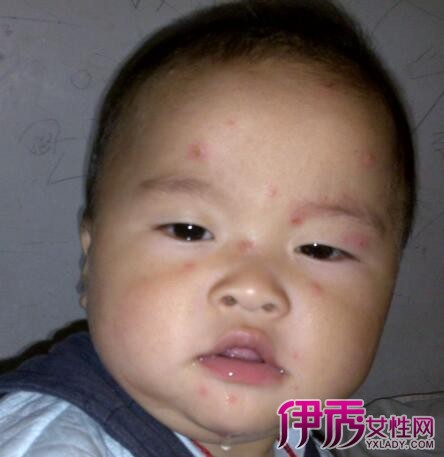 水痘不能吃的食物_出水痘饮食禁忌_水痘饮食吃什么
