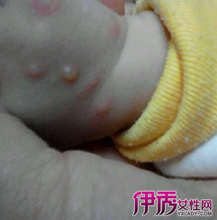 出水痘饮食禁忌_水痘不能吃的食物_水痘饮食吃什么